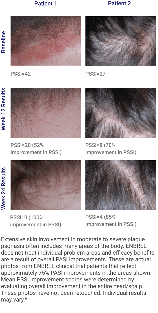 Patient photos from Enbrel® (etanercept) scalp involvement study