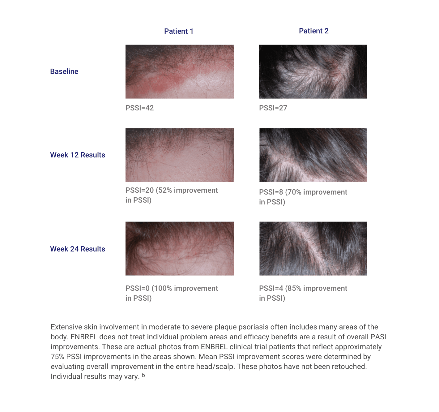 Patients from the scalp involvement study with baseline, week 12, and week 24 results for Enbrel® (etanercept) show improvement
