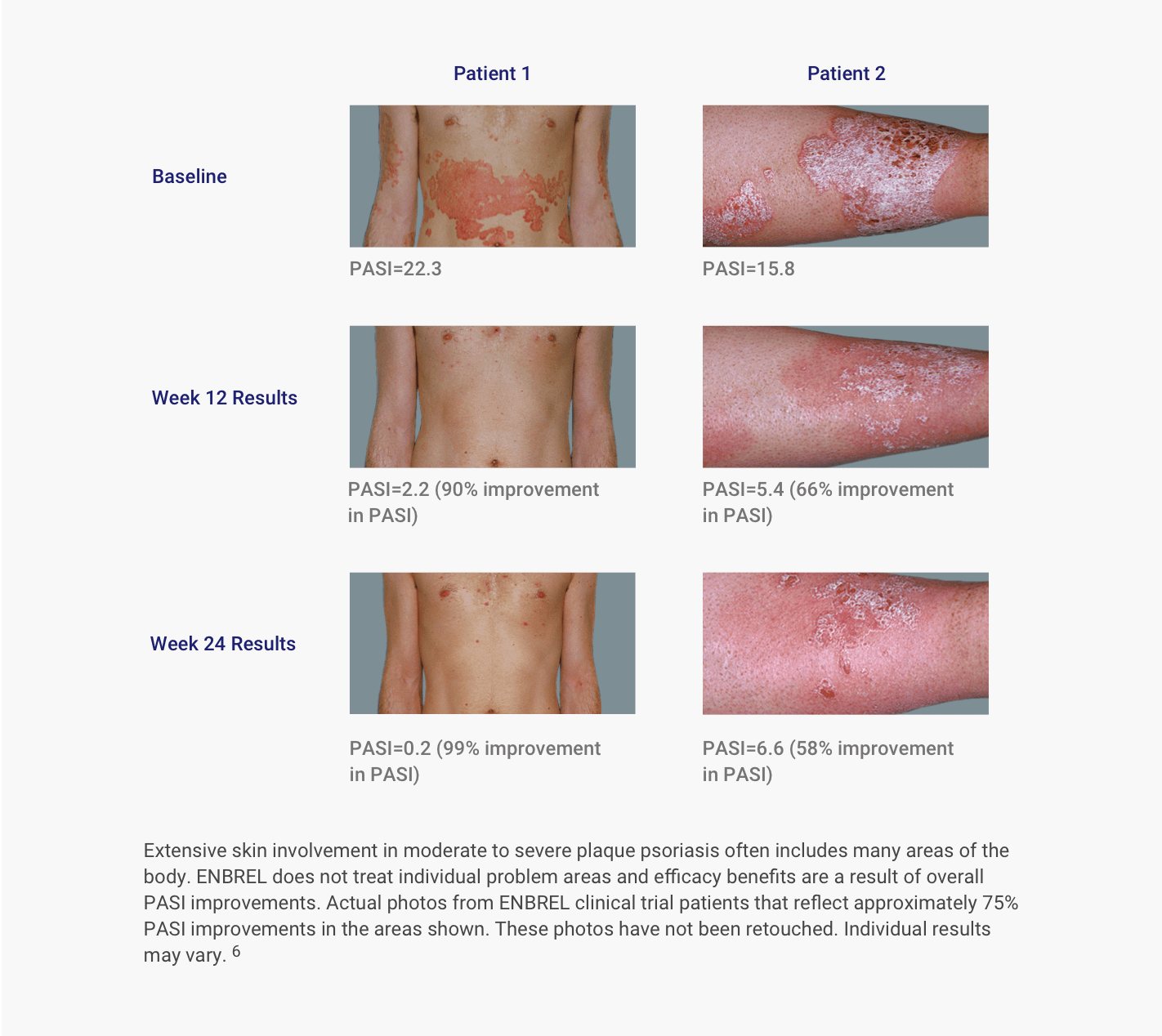 Plaque Psoriasis (PsO) Clinical Trials Enbrel® (etanercept)