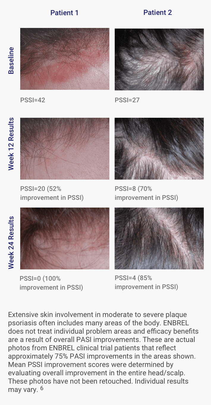 Patients from the scalp involvement study with baseline, week 12, and week 24 results for Enbrel® (etanercept) show improvement