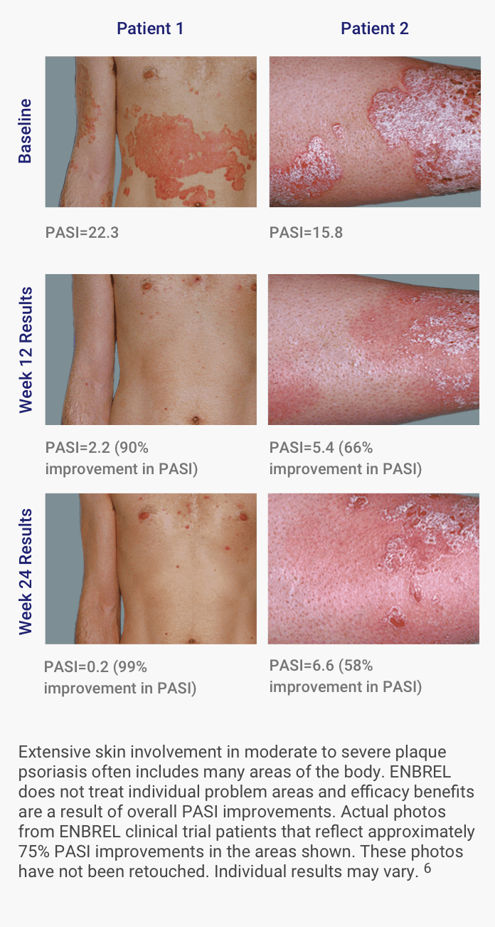 Patients from the Global Psoriasis Pivotal Trial show improvements from baseline, to week 12, to week 24 for Enbrel® (etanercept)
